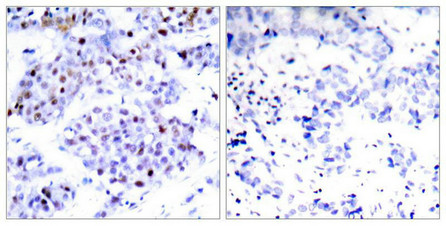 Immunohistochemical analysis of paraffin-embedded human breast carcinoma tissue using STAT6(Ab-645) Antibody(left) or the same antibody preincubated with blocking peptide(right).
