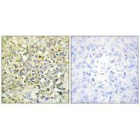Immunohistochemistry analysis of paraffin-embedded human lung carcinoma tissue using CDKL4 antibody.