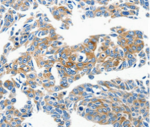 Immunohistochemical analysis of paraffin-embedded Human lung cancer tissue using at dilution 1/50. Immunohistochemical analysis of paraffin-embedded Human lung cancer tissue using at dilution 1/50.