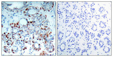 Immunohistochemical analysis of paraffin-embedded human breast carcinoma tissue using BIM(Phospho-Ser69) Antibody(left) or the same antibody preincubated with blocking peptide(right). Immunohistochemical analysis of paraffin-embedded human breast carcinoma tissue using BIM(Phospho-Ser69) Antibody(left) or the same antibody preincubated with blocking peptide(right).
