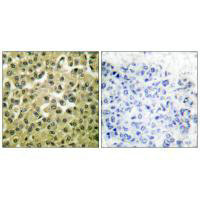 Immunohistochemical analysis of paraffin-embedded human breast carcinoma tissue using MCL1 antibody. Immunohistochemical analysis of paraffin-embedded human breast carcinoma tissue using MCL1 antibody.