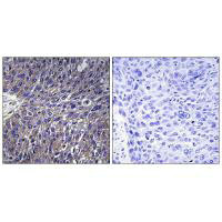Immunohistochemistry analysis of paraffin-embedded human lung carcinoma tissue using USP50 antibody.