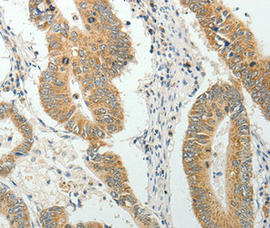 Immunohistochemical analysis of paraffin-embedded Human colon cancer tissue using at dilution 1/40. Immunohistochemical analysis of paraffin-embedded Human colon cancer tissue using at dilution 1/40.