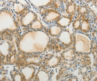 Immunohistochemical analysis of paraffin-embedded Human thyroid cancer tissue using at dilution 1/40.