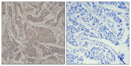 Immunohistochemical analysis of paraffin-embedded human breast carcinoma tissue using Smad3(Ab-425) Antibody(left) or the same antibody preincubated with blocking peptide(right). Immunohistochemical analysis of paraffin-embedded human breast carcinoma tissue using Smad3(Ab-425) Antibody(left) or the same antibody preincubated with blocking peptide(right).