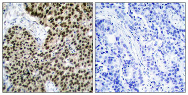 Immunohistochemical analysis of paraffin-embedded human breast carcinoma tissue using HSF1(Ab-303) Antibody(left) or the same antibody preincubated with blocking peptide(right).