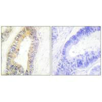 Immunohistochemistry analysis of paraffin-embedded human colon carcinoma tissue using ZNF638 antibody.