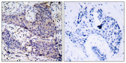 Immunohistochemical analysis of paraffin-embedded human breast carcinoma tissue using BAD(Ab-136) Antibody(left) or the same antibody preincubated with blocking peptide(right).