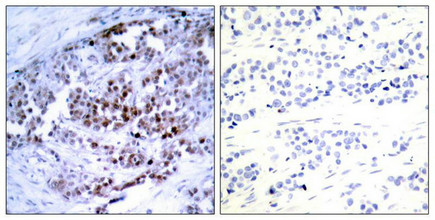 Immunohistochemical analysis of paraffin-embedded human breast carcinoma, using BCL-2 (phospho-Ser70) antibody. Immunohistochemical analysis of paraffin-embedded human breast carcinoma, using BCL-2 (phospho-Ser70) antibody.