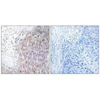 Immunohistochemistry analysis of paraffin-embedded human cervix carcinoma tissue using POLG2 antibody. Immunohistochemistry analysis of paraffin-embedded human cervix carcinoma tissue using POLG2 antibody.