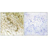 Immunohistochemistry analysis of paraffin-embedded human prostate carcinoma tissue, using PDZD2 antibody. Immunohistochemistry analysis of paraffin-embedded human prostate carcinoma tissue, using PDZD2 antibody.