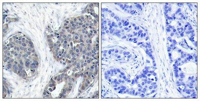 Immunohistochemical analysis of paraffin-embedded human breast carcinoma tissue using Stathmin 1(Ab-38) Antibody(left) or the same antibody preincubated with blocking peptide(right).