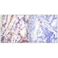 Immunohistochemical analysis of paraffin-embedded human lung carcinoma tissue using HDAC9 antibody.