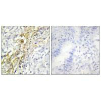 Immunohistochemistry analysis of paraffin-embedded human lung carcinoma tissue using CKI-alpha antibody.