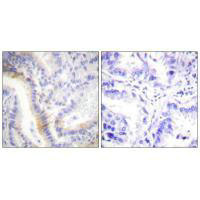 Immunohistochemistry analysis of paraffin-embedded human lung carcinoma tissue, using urocortin antibody. Immunohistochemistry analysis of paraffin-embedded human lung carcinoma tissue, using urocortin antibody.