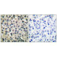 Immunohistochemical analysis of paraffin-embedded human breast carcinoma tissue using Catenin-gamma antibody.