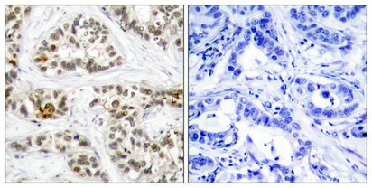 Immunohistochemical analysis of paraffin-embedded human breast carcinoma tissue using RelB(Phospho-Ser573) Antibody(left) or the same antibody preincubated with blocking peptide(right).