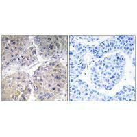 Immunohistochemistry analysis of paraffin-embedded human liver carcinoma tissue using SLC27A5 antibody.