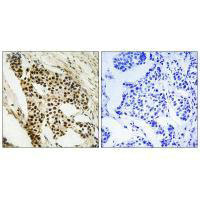 Immunohistochemistry analysis of paraffin-embedded human breast carcinoma tissue using MAPKAPK2 (Ab-272) antibody.