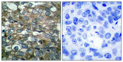 Immunohistochemical analysis of paraffin-embedded human breast carcinoma tissue using EGFR(Ab-869) Antibody(left) or the same antibody preincubated with blocking peptide(right).