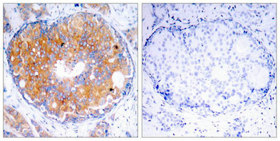 Immunohistochemical analysis of paraffin-embedded human breast carcinoma tissue using MEK-2(Ab-394) Antibody(left) or the same antibody preincubated with blocking peptide(right).