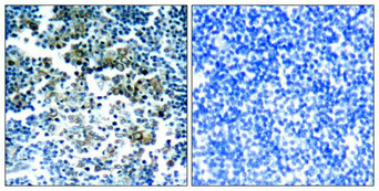 Immunohistochemical analysis of paraffin-embedded human tonsil tumor tissue using Bcr(Phospho-Tyr177) Antibody(left) or the same antibody preincubated with blocking peptide(right).