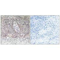 Immunohistochemistry analysis of paraffin-embedded human cervix carcinoma tissue using ARSA antibody.