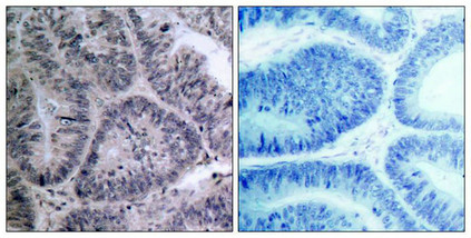 Immunohistochemical analysis of paraffin-embedded human colon carcinoma tissue using IKK a(Ab-23) Antibody(left) or the same antibody preincubated with blocking peptide(right).
