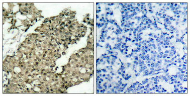 Immunohistochemical analysis of paraffin-embedded human breast carcinoma tissue using G3BP-1(Phospho-Ser232) Antibody(left) or the same antibody preincubated with blocking peptide(right).