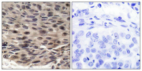 Immunohistochemical analysis of paraffin-embedded human breast carcinoma, using 4E-BP1 (phospho-Thr36) antibody.