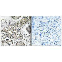 Immunohistochemistry analysis of paraffin-embedded human breast carcinoma tissue using USP6NL antibody. Immunohistochemistry analysis of paraffin-embedded human breast carcinoma tissue using USP6NL antibody.