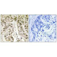 Immunohistochemistry analysis of paraffin-embedded human breast carcinoma tissue, using HCFC1 antibody. Immunohistochemistry analysis of paraffin-embedded human breast carcinoma tissue, using HCFC1 antibody.