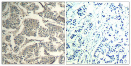 Immunohistochemical analysis of paraffin-embedded human breast carcinoma tissue using cofilin1/cofilin2(Ab-88) Antibody(left) or the same antibody preincubated with blocking peptide(right).