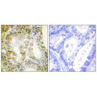 Immunohistochemistry analysis of paraffin-embedded human colon carcinoma tissue using Catenin-beta1 antibody.