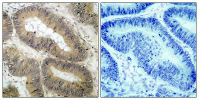 Immunohistochemical analysis of paraffin-embedded human colon carcinoma tissue using IKK a(Phospho-Thr23) Antibody(left) or the same antibody preincubated with blocking peptide(right).