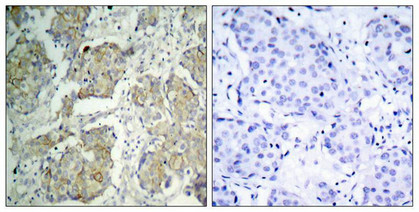 Immunohistochemical analysis of paraffin-embedded human breast carcinoma tissue using VEGFR2(Phospho-Tyr1214) Antibody(left) or the same antibody preincubated with blocking peptide(right).