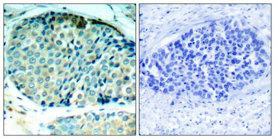 Immunohistochemical analysis of paraffin-embedded human breast carcinoma tissue using HSP27(Phospho-Ser78) Antibody(left) or the same antibody preincubated with blocking peptide(right).
