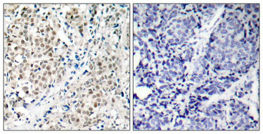 Immunohistochemical analysis of paraffin-embedded human breast carcinoma tissue using Myc(Ab-358) Antibody(left) or the same antibody preincubated with blocking peptide(right).