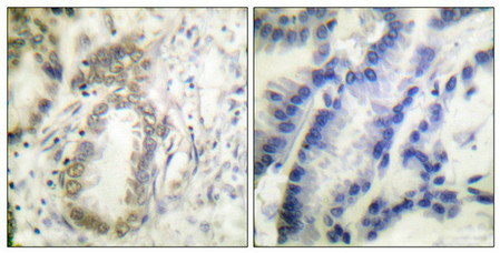 Immunohistochemical analysis of paraffin-embedded human colon carcinoma tissue using C/EBP-alpha (phospho-Ser21) antibody (left)or the same antibody preincubated with blocking peptide (right).