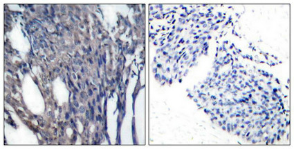 Immunohistochemical analysis of paraffin-embedded human breast carcinoma tissue using IkB-a(phospho-Tyr42) antibody.