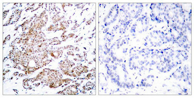 Immunohistochemical analysis of paraffin-embedded human breast carcinoma tissue using Myc(Phospho-Thr58) Antibody(left) or the same antibody preincubated with blocking peptide(right).