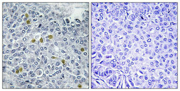 Immunohistochemistry analysis of paraffin-embedded human breast carcinoma tissue using TOP2A (Phospho-Ser1106) antibody. The picture on the right is treated with the synthesized peptide.