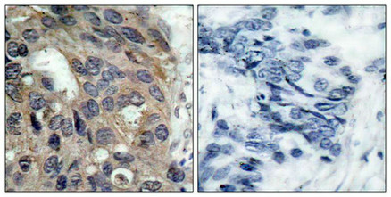 Immunohistochemical analysis of paraffin-embedded human breast carcinoma tissue using Src(Phospho-Tyr529) Antibody(left) or the same antibody preincubated with blocking peptide(right).