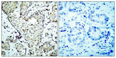 Immunohistochemical analysis of paraffin-embedded human breast carcinoma tissue using MKK6(Ab-207) Antibody(left) or the same antibody preincubated with blocking peptide(right).