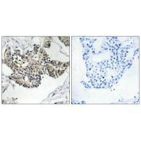 Immunohistochemistry analysis of paraffin-embedded human breast carcinoma tissue, using RSAD1 antibody.