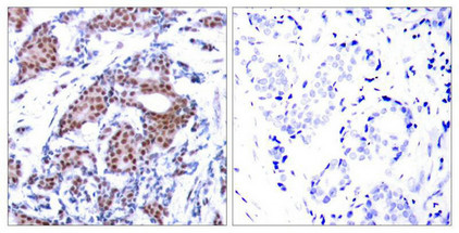 Immunohistochemical analysis of paraffin-embedded human breast carcinoma tissue using Elk-1(Phospho-Ser383) Antibody(left) or the same antibody preincubated with blocking peptide(right).