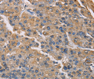 Immunohistochemical analysis of paraffin-embedded Human liver cancer tissue using at dilution 1/50. Immunohistochemical analysis of paraffin-embedded Human liver cancer tissue using at dilution 1/50.
