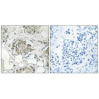 Immunohistochemistry analysis of paraffin-embedded human breast carcinoma tissue, using USP13 antibody.