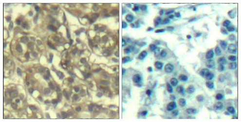 Immunohistochemical analysis of paraffin-embedded human breast carcinoma tissue using Cyclin B1(Ab-147) Antibody(left) or the same antibody preincubated with blocking peptide(right).