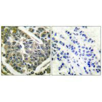 Immunohistochemical analysis of paraffin-embedded human breast carcinoma tissue using Collagen IV antibody.